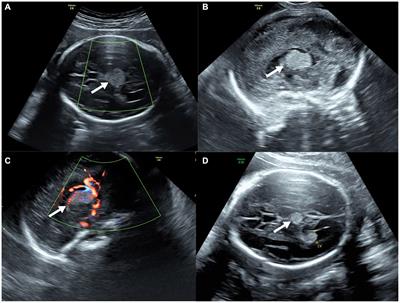 Prenatal diagnosis of fetal intracranial medulloepithelioma: a case report